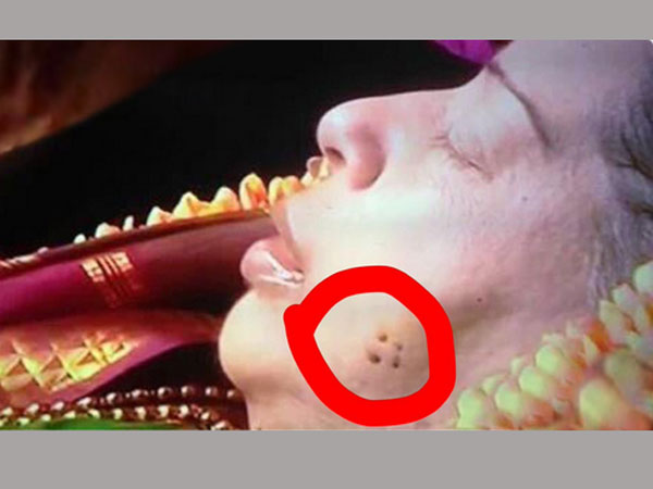 Small Holes Found on Jayalalitha Face Small Holes Found on Jayalalitha Face