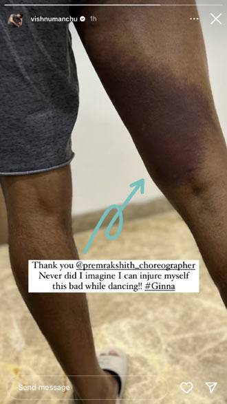 Hero manchu Vishnu injured badly on Ginna movie shooting Hero manchu Vishnu injured badly on Ginna movie shooting